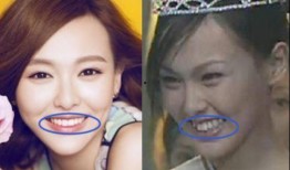 牙医爆料明星整牙视频播放,牙医亲述整牙全过程